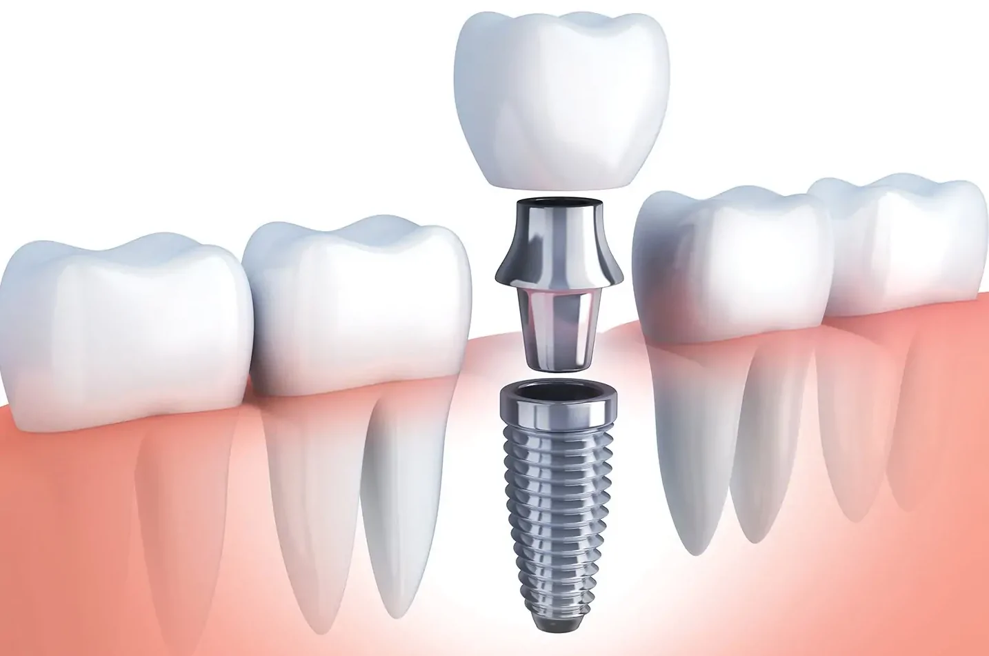 How Dental Implants Enhance Oral Health and Confidence