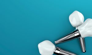 Navigating the Emotional Journey of Getting Dental Implants