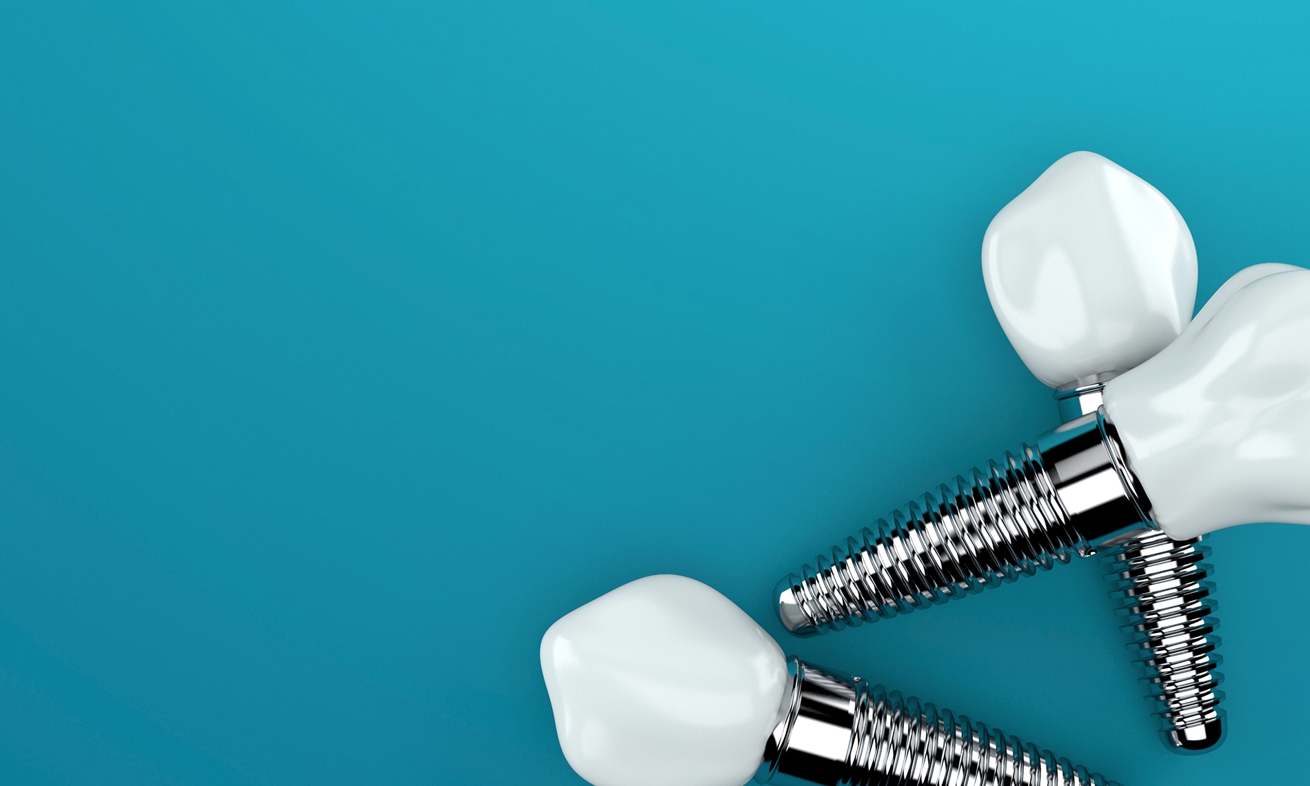 Navigating the Emotional Journey of Getting Dental Implants