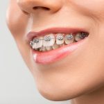 The Hidden Benefits of Braces: Beyond Aesthetic Transformations