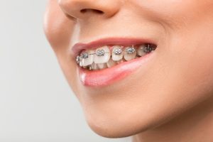 The Hidden Benefits of Braces: Beyond Aesthetic Transformations